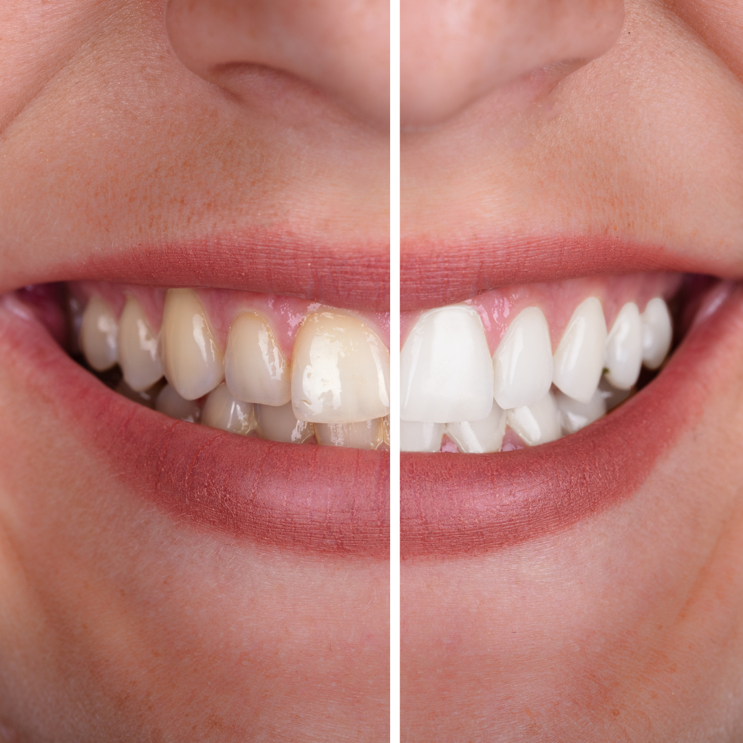 Clareamento dental com a Dra. Juliana Montes